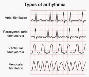 an irregular heartbeat figgerits answers|Understanding Arrhythmia: Causes, Symptoms, and .